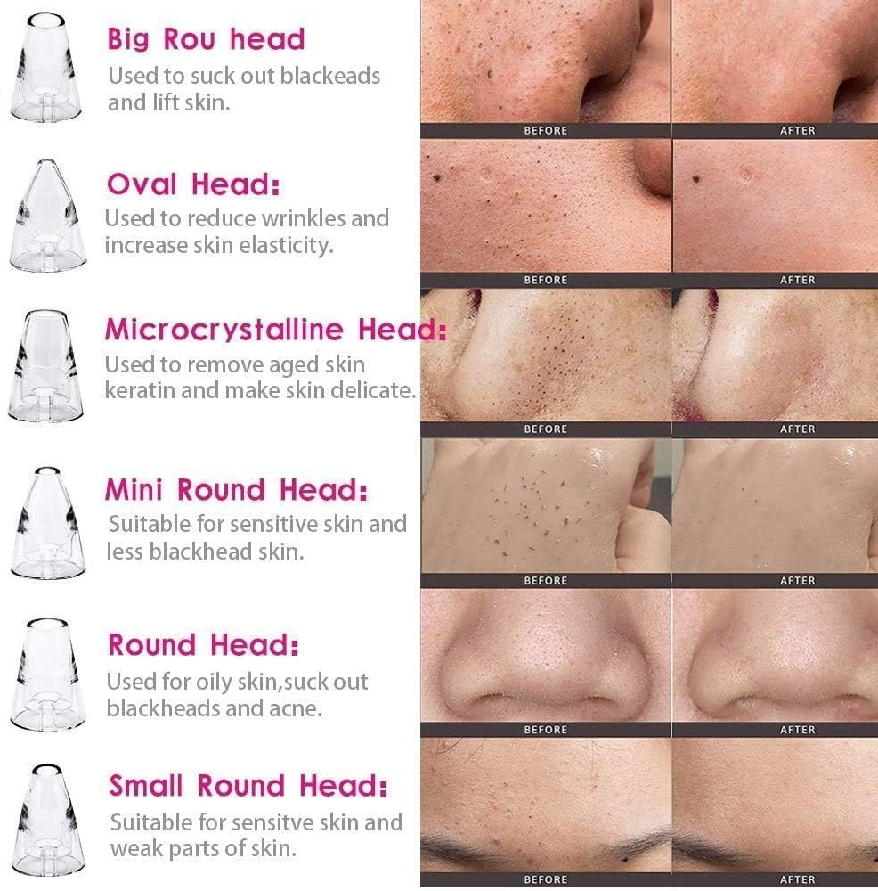 Blackhead Remover Tools | Electric Derma suction Machine | USB Rechargeable Acne Pimple Pore Cleaner Vacuum tool | Facial Cleanser Device for Nose & Skin Care