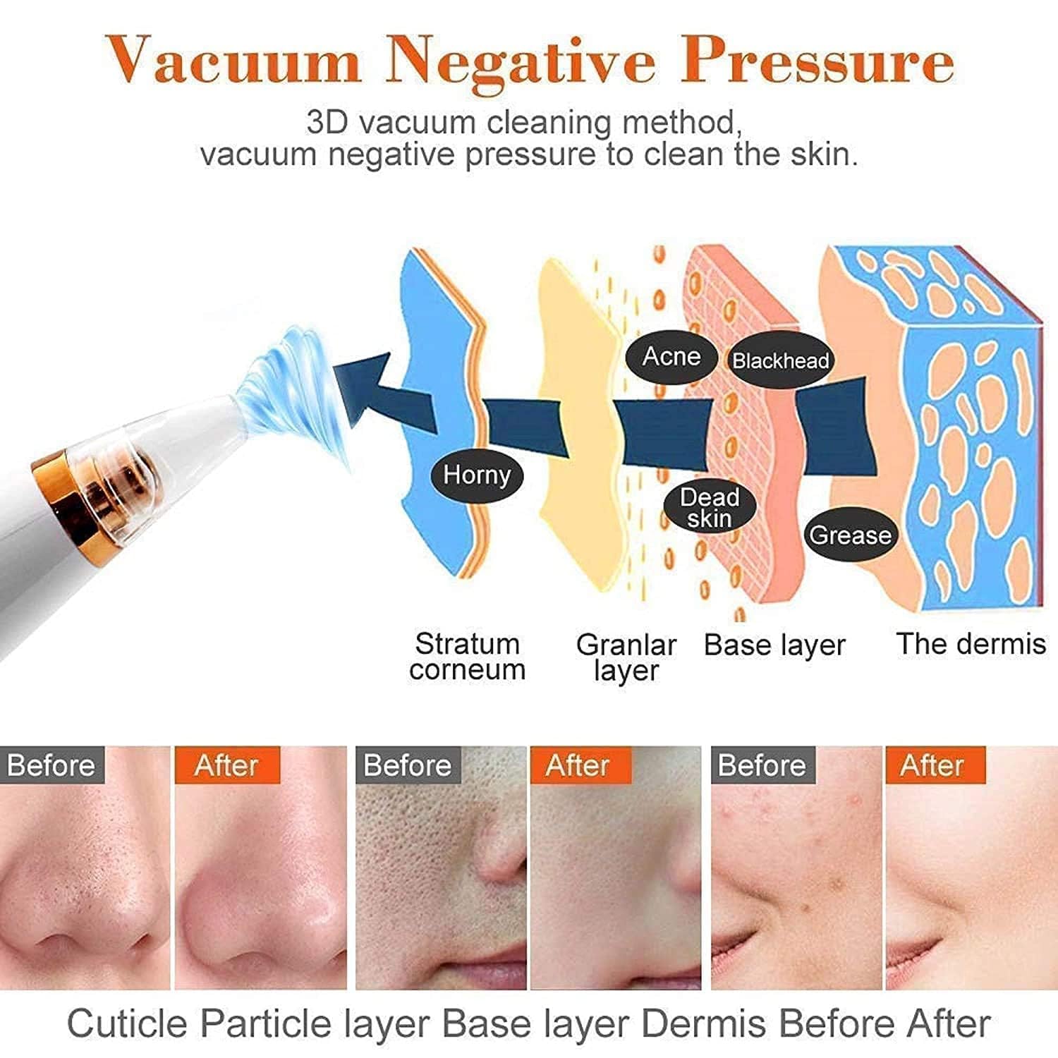 Blackhead Remover Tools | Electric Derma suction Machine | USB Rechargeable Acne Pimple Pore Cleaner Vacuum tool | Facial Cleanser Device for Nose & Skin Care